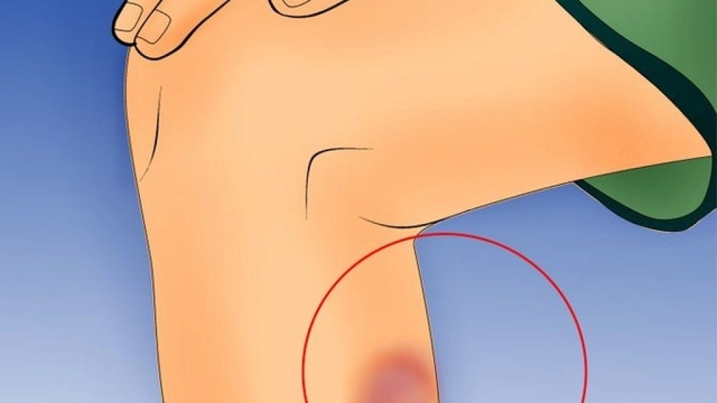 25-07-2016_18-54-101-671px-Treat-a-Torn-Muscle-Step-1Bullet3, 