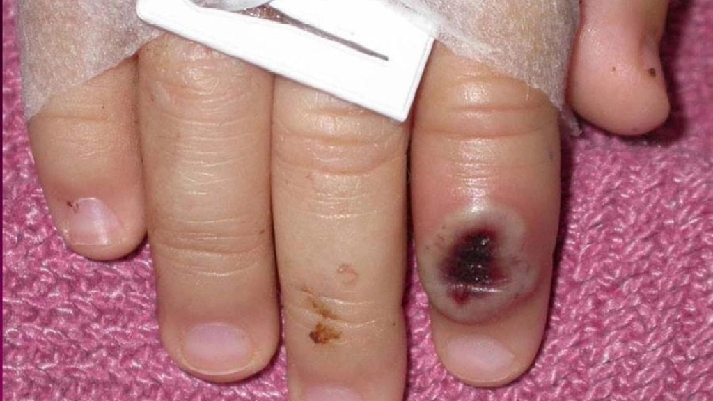 4f129c86b6e9aa5a59b352dacab7ecdb2e645198miniw, Imagen del Centro Estadounidense de Control de las Enfermedades (CDC) en la que se aprecia el dedo de un niño infectado por la viruela de mono. EFE/Cortesía CDC