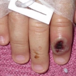 4f129c86b6e9aa5a59b352dacab7ecdb2e645198miniw, Imagen del Centro Estadounidense de Control de las Enfermedades (CDC) en la que se aprecia el dedo de un niño infectado por la viruela de mono. EFE/Cortesía CDC
