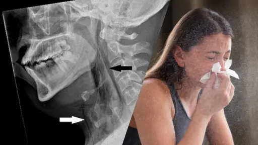 Desgarro de garganta por aguantar un estornudo: ¿Qué otras consecuencias evidencian los expertos?