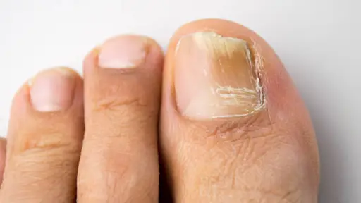 ¿Crees que te ha aparecido un hongo en el cuerpo? Aprende sobre las infecciones de hongos y cómo cuidarte de ellas este verano