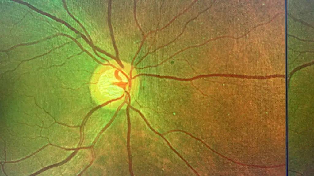Nervio óptico afectado por glaucoma, Cedida