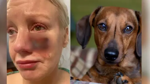 Mujer quedó desfigurada tras brutal ataque de perro salchicha: El can le arrancó la mejilla y luego se la comió
