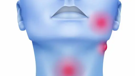 Más de 200 personas han muerto por cáncer de cabeza y cuello en la región del Biobío