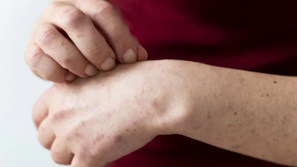 Los síntomas iniciales incluyen la aparición erupciones en forma de ampollas que producen picor., freepik.es