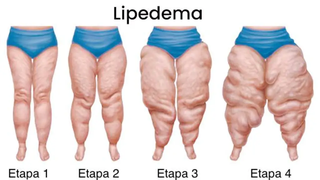 Etapas del Lipedema, Cedida