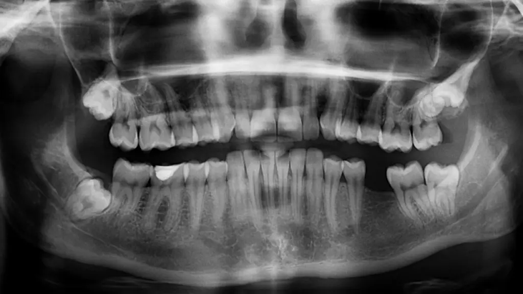 dientes, radiografía, ortopantomografía, Pixabay