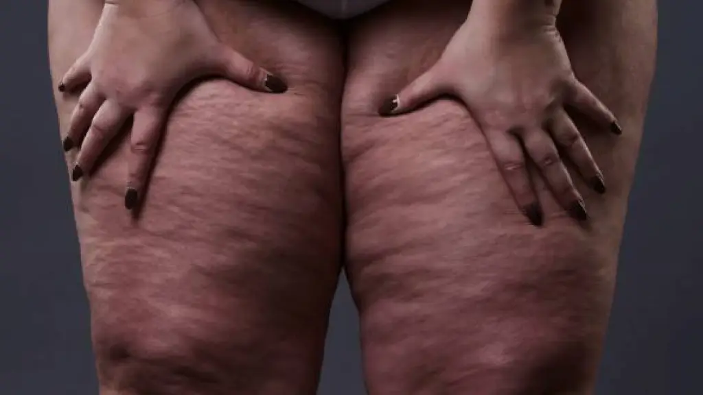 Lipedema contexto, internet