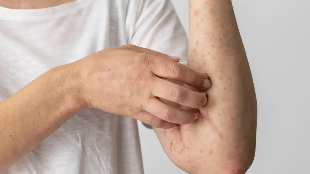 El período de incubación de la varicela puede extenderse desde los diez hasta los 21 días, dependiendo de la carga viral a la que se expuso la persona / Contexto, Freepik