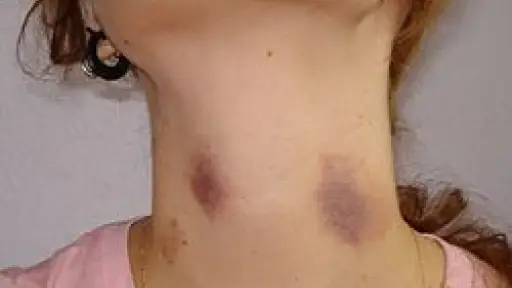 Mujer resulto con lesiones leves tras ser agredida por su pareja en Yumbel