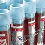 El VIH puede detectarse mediante el examen ELISA, considerado el test estándar., Freepik