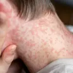 El sarampión comienza con síntomas similares a un resfriado, fiebre superior a 38°C, conjuntivitis, inflamación de ganglios y pequeños puntos blancos en la boca. Eso, antes de la aparición de sarpullidos., Freepik
