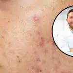 Acné y Sol, Diario La Tribuna