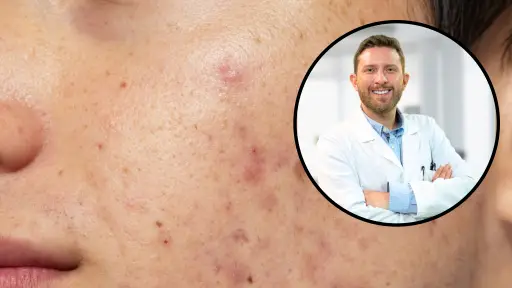 El sol no seca el acné: Experto advierte sobre los peligros de la radiación en verano
