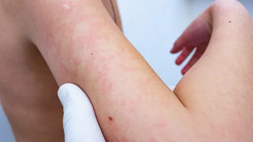 Brote de eritema infeccioso en Victoria: casos aumentan a 26 estudiantes y Salud refuerza vigilancia
