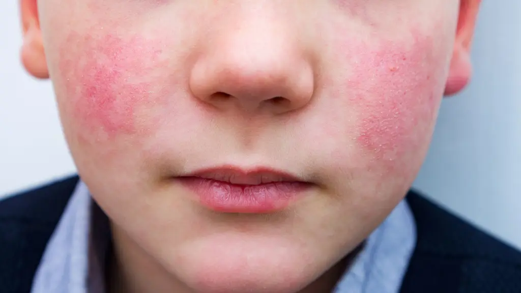 La enfermedad, causada por el parvovirus B19, suele afectar a niños en edad escolar y se caracteriza por un llamativo enrojecimiento en las mejillas., contexto