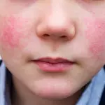 La enfermedad, causada por el parvovirus B19, suele afectar a niños en edad escolar y se caracteriza por un llamativo enrojecimiento en las mejillas., contexto