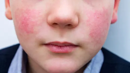 Brote de Eritema infeccioso en Victoria: qué es el quinta enfermedad que afecta a niños en edad escolar