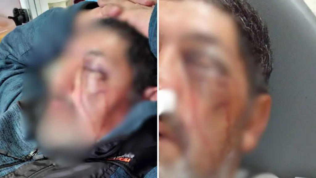 Hombre quedó con fractura ocular tras ser agredido en Los Ángeles: “Tuvo que ser trasladado a Santiago”, La Tribuna