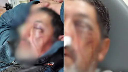 Hombre quedó con fractura ocular tras ser agredido en semáforo de Los Ángeles: 