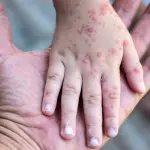 MINSAL alerta por más de 140 mil niños sin esquema completo contra el sarampión, contexto