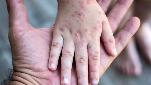 Minsal alerta por más de 140 mil niños sin esquema completo contra el sarampión